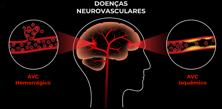 Clínica de Neurologia e Distúrbios do Sono – AVC Isquêmico e Hemorrágico Clínica de Neurologia e Distúrbios do Sono - AVC Isquêmico e Hemorrágico